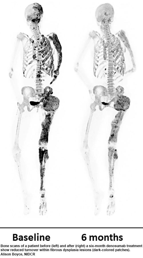 NIH 20230404 bones