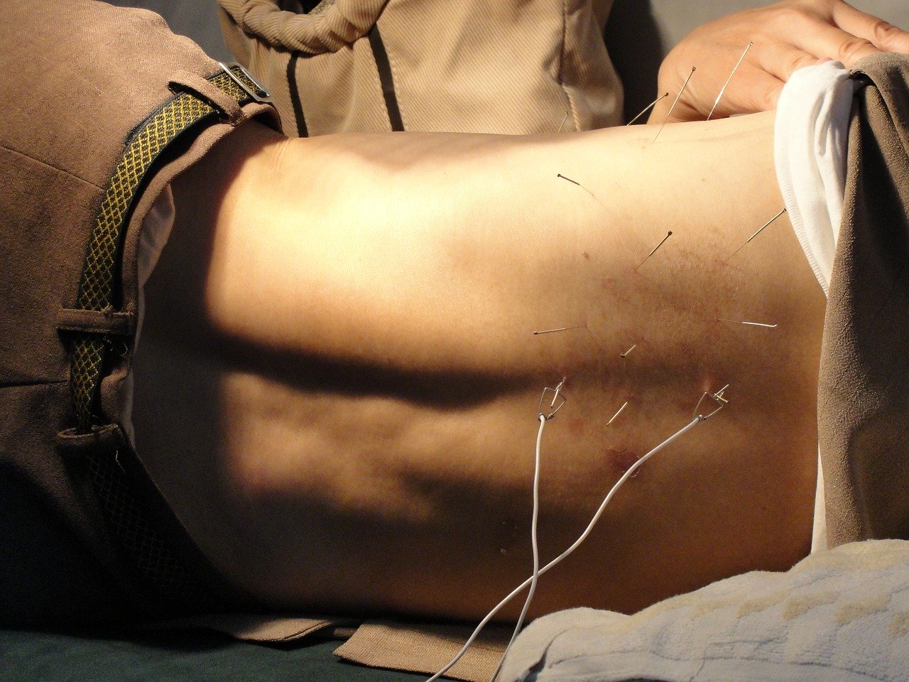 acupuncture 3275458 1280