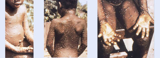 monkeypox homepage images 3