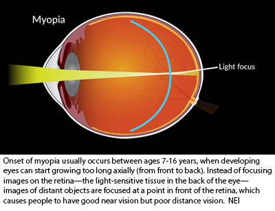 NIH 20230713 myopia