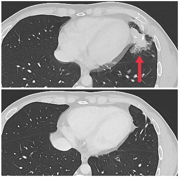 NIH 20240711 immunotherapy scans