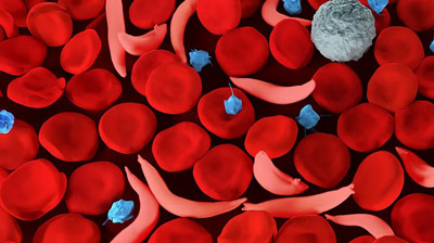 NIH 20240912 sickle cell