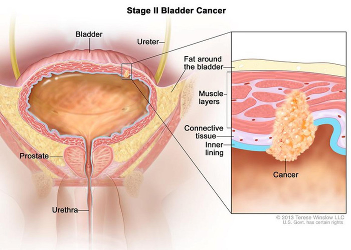 NIH 20240916 muscle invasive bladder cancer