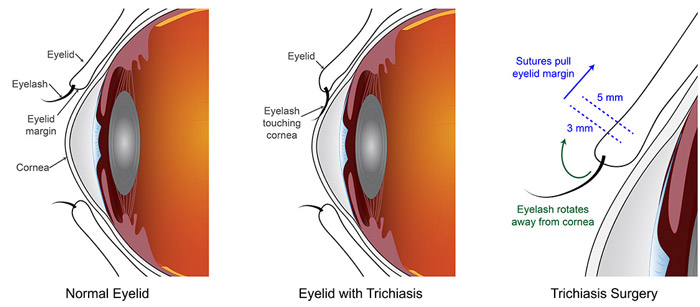 NIH 20240917 trichiasis schematic