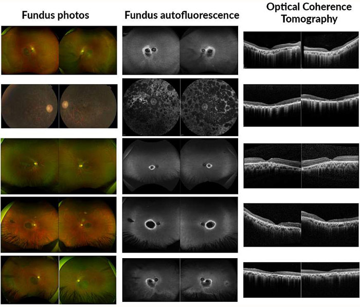 NIH 20240926 eye disease cropped