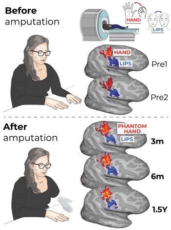 NIH 20250821 amputation