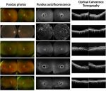 Scientists Discover Gene Responsible for Rare, Inherited Eye Disease, NIH Reports